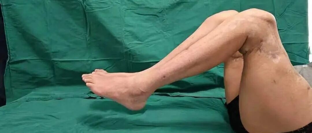 世界首例双大腿完全离断再植成功，患者已能借助助行器行走 配图